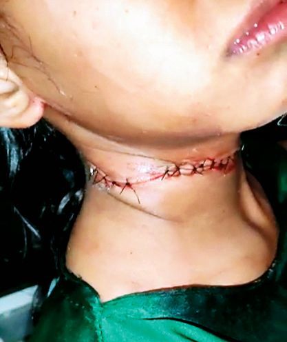 Be careful! The nylon sheath cuts the artery that supplies blood to the brain | सावध व्हा! नायलॉन मांजामुळे मेंंदूला रक्तपुरवठा करणारी धमनीच कापली जाते Be careful! The nylon sheath cuts the artery that supplies blood to the brain | सावध व्हा! नायलॉन मांजामुळे मेंंदूला रक्तपुरवठा करणारी धमनीच कापली जाते