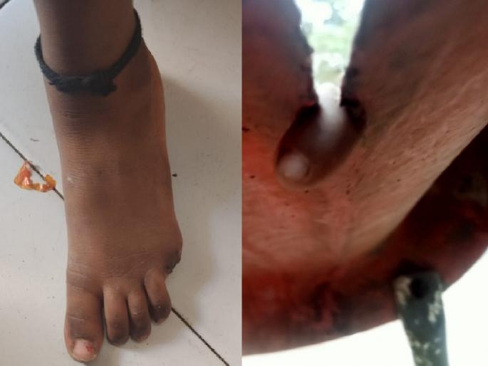 Toddler breaks little finger after falling on a slide while playing in the garden in kolhapur | Kolhapur: बागेत खेळताना घसरगुंडीत अडकून चिमुकलीची करंगळी तुटली, जबाबदार कोण ?