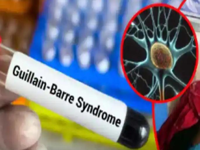 First GBS patient found in Jalna district; Treatment underway in private hospital | जालन्यात ‘जीबीएस’चा पहिला रुग्ण; परराज्यातून आल्यानंतर तब्येत बिघडली, रिपोर्ट पॉझिटिव्ह First GBS patient found in Jalna district; Treatment underway in private hospital | जालन्यात ‘जीबीएस’चा पहिला रुग्ण; परराज्यातून आल्यानंतर तब्येत बिघडली, रिपोर्ट पॉझिटिव्ह