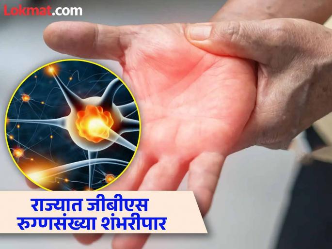 The prevalence of GBS is increasing in the state; the number of patients has crossed 100, 17 people are on ventilators | राज्यात जीबीएसचा प्रादुर्भाव वाढतोय; रुग्णसंख्या शंभरीपार, १७ जण व्हेंटिलेटरवर   The prevalence of GBS is increasing in the state; the number of patients has crossed 100, 17 people are on ventilators | राज्यात जीबीएसचा प्रादुर्भाव वाढतोय; रुग्णसंख्या शंभरीपार, १७ जण व्हेंटिलेटरवर