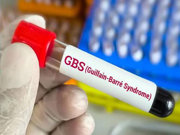 First death of GBS patient in Sangli | सांगलीत जीबीएस रुग्णाचा पहिला बळी, महापालिकेचा आरोग्य विभाग सतर्क First death of GBS patient in Sangli | सांगलीत जीबीएस रुग्णाचा पहिला बळी, महापालिकेचा आरोग्य विभाग सतर्क