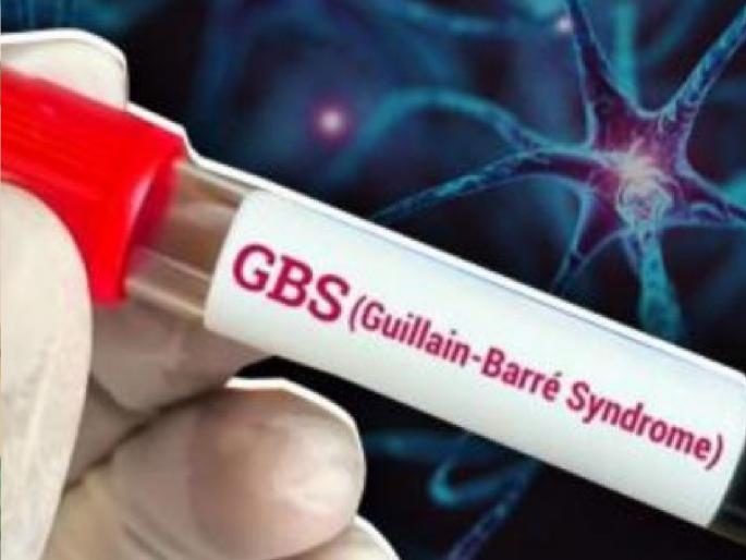 Six suspected cases of GBS syndrome were found in Sangli | सांगलीत जीबीएस सिंड्रोमचा शिरकाव, सहा संशयित रुग्ण आढळले  Six suspected cases of GBS syndrome were found in Sangli | सांगलीत जीबीएस सिंड्रोमचा शिरकाव, सहा संशयित रुग्ण आढळले