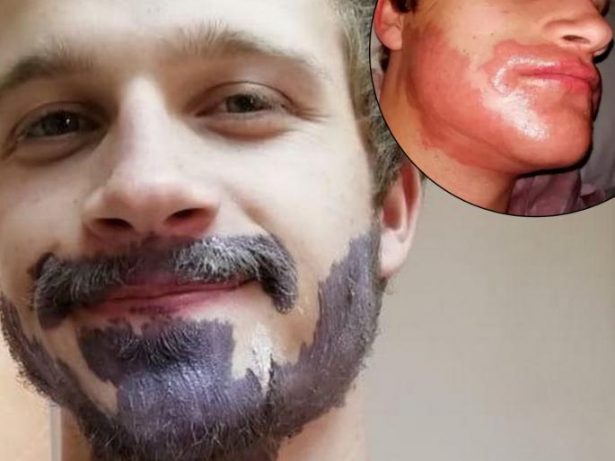 Man's girlfriend dyes his beard 'for fun' and it goes horrifically wrong | गर्लफ्रेंडच्या सांगण्यावरून दाढी, मिशी काळी करत असाल तर सावधान! आधी हे वाचा Man's girlfriend dyes his beard 'for fun' and it goes horrifically wrong | गर्लफ्रेंडच्या सांगण्यावरून दाढी, मिशी काळी करत असाल तर सावधान! आधी हे वाचा