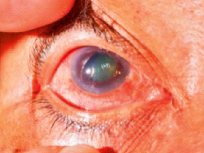 Take glaucoma seriously | काचबिंदू गंभीरपणे घ्या... Take glaucoma seriously | काचबिंदू गंभीरपणे घ्या...