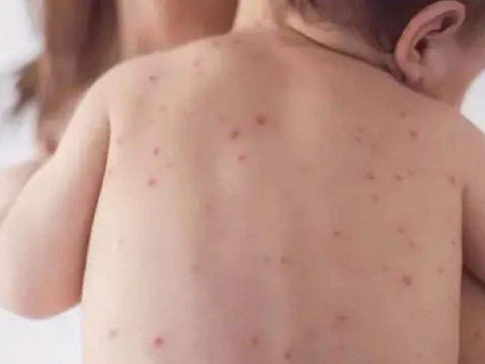 The second victim of measles in Thane was a one-and-a-half-year-old child | ठाण्यात गोवरचा दुसरा बळी, दीड वर्षीय मूल दगावले The second victim of measles in Thane was a one-and-a-half-year-old child | ठाण्यात गोवरचा दुसरा बळी, दीड वर्षीय मूल दगावले