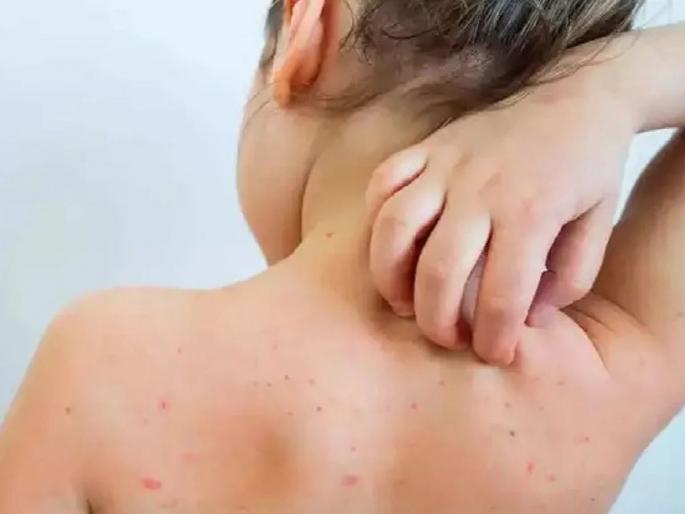 Measles-rubella vaccination in six districts in the state only on paper? Shocking information in the survey of WHO | 'या' जिल्ह्यांमध्ये गोवर-रुबेला लसीकरण कागदोपत्रीच? WHOच्या सर्वेक्षणात धक्कादायक माहिती पुढे Measles-rubella vaccination in six districts in the state only on paper? Shocking information in the survey of WHO | 'या' जिल्ह्यांमध्ये गोवर-रुबेला लसीकरण कागदोपत्रीच? WHOच्या सर्वेक्षणात धक्कादायक माहिती पुढे