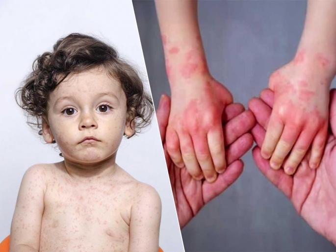 Measles symptoms and treatment for kids How to care for a child with measles at home Home care tips for measles in babies | बाळाला गोवर झाला तर काय कराल? घाबरुन चुकीचे घरगुती उपचार करु नका, बाळाचा जीव महत्वाचा.. Measles symptoms and treatment for kids How to care for a child with measles at home Home care tips for measles in babies | बाळाला गोवर झाला तर काय कराल? घाबरुन चुकीचे घरगुती उपचार करु नका, बाळाचा जीव महत्वाचा..