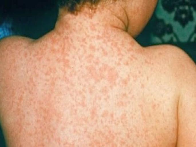 Another 25-year-old youth has measles, health department in nagpur on alert | पुन्हा एका २५ वर्षीय युवकाला गोवर, आरोग्य विभाग सतर्क Another 25-year-old youth has measles, health department in nagpur on alert | पुन्हा एका २५ वर्षीय युवकाला गोवर, आरोग्य विभाग सतर्क
