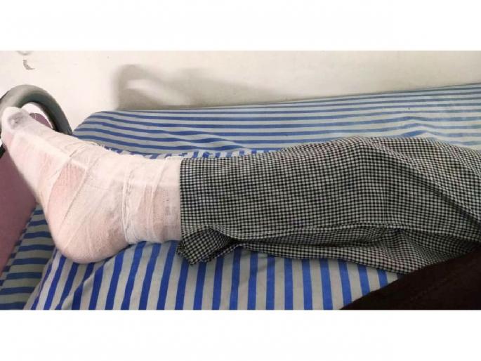 Banned nylon manja stucks in girl's leg and cut the leg bone | पायात मांजा अडकला अन् तरुणीच्या पायाचे हाडच कापले Banned nylon manja stucks in girl's leg and cut the leg bone | पायात मांजा अडकला अन् तरुणीच्या पायाचे हाडच कापले