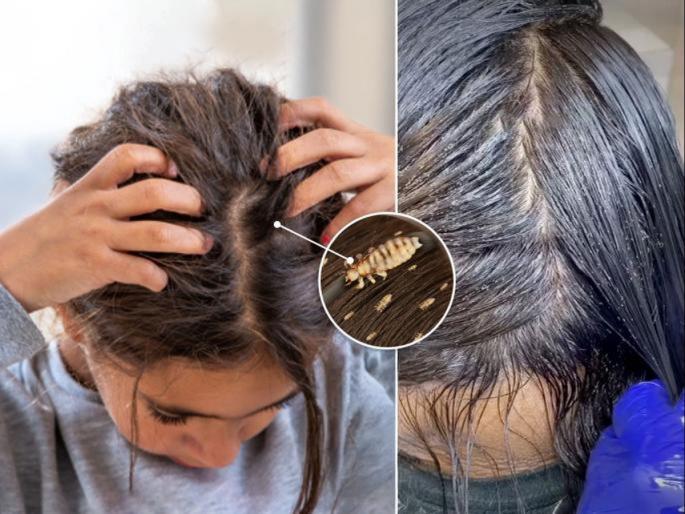 Got a lot of lice in your hair? especially during the monsoon? Try these 3 remedies, home remedies | केसात खुप उवा झाल्या, पावसाळ्यात तर जास्तच? करा आजीच्या काळातले ३ हमखास रामबाण उपाय