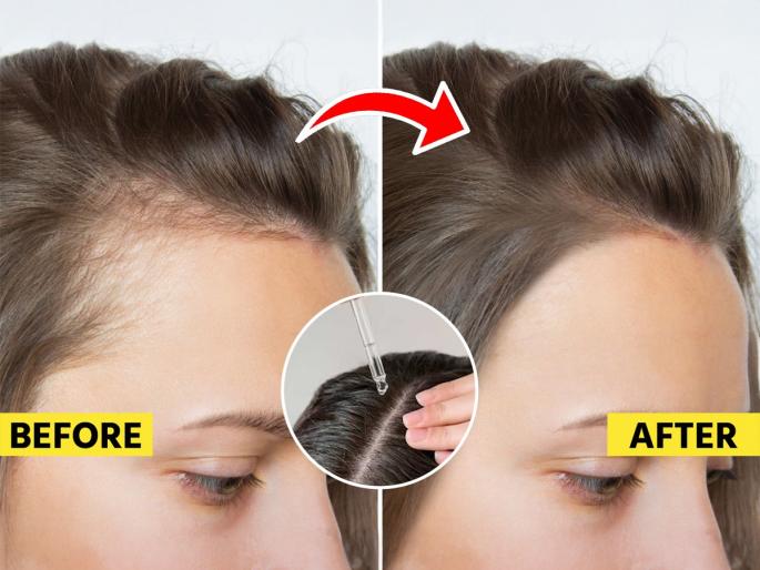 baby hair growth remedies, home hacks for reducing hair loss, how to get rid of hair fall  | डोक्याच्या समोरच्या भागातले केस गळून टक्कल पडू लागलं? करा कोथिंबिरीचा उपाय, केस वाढतील भरभर