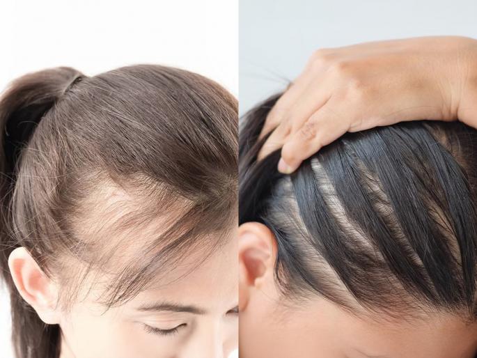thinning hair can cause baldness, before trying out remedies learn about reasons | केस एवढे विरळ की टक्कलच पडल्यासारखे वाटते? लाख उपाय करुनही फायदा नाही? कारण 'हे ' चुकते..