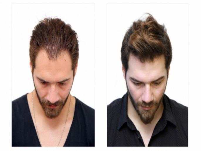 Moving towards hair transplantation | केशप्रत्यारोपणाकडे वाढतोय कल