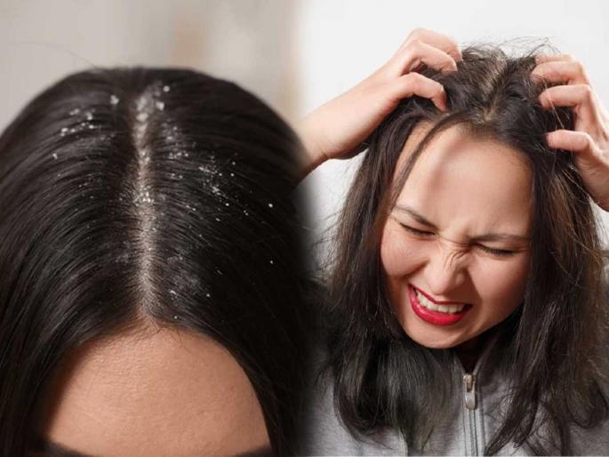 Unbearable itching in the hair can be very annoying, avoid constant scratching and try simple remedies at home. | डोक्यात प्रचंड खाज येते, खसाखसा चारचौघात केसात हात घालणं लाजीरवाणं, पाहा ५ हमखास असरदार उपाय Unbearable itching in the hair can be very annoying, avoid constant scratching and try simple remedies at home. | डोक्यात प्रचंड खाज येते, खसाखसा चारचौघात केसात हात घालणं लाजीरवाणं, पाहा ५ हमखास असरदार उपाय