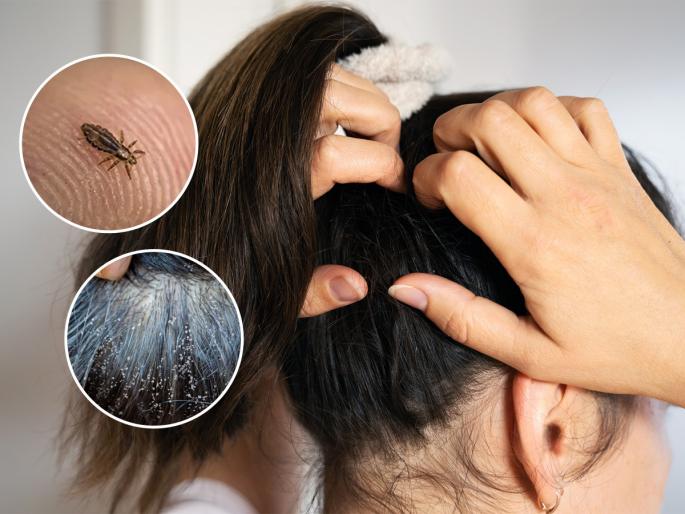 itchy scalp remedies in monsoon how to get rid of lice naturally hair care tips for rainy season | पावसाळ्यात डोक्याला खाज सुटते, उवा-लिखा झाल्या? ५ सोपे उपाय - केसांच्या समस्या होतील दूर
