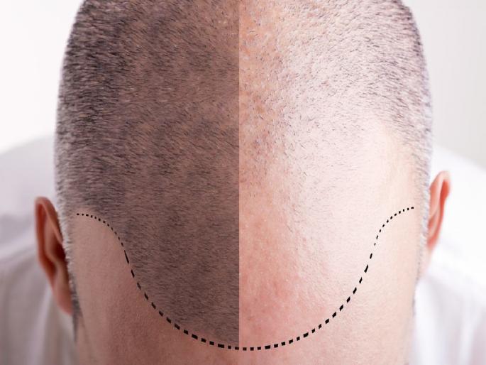 fake 'hair transplant' racket in Nagpur, Many lives are in danger | नागपुरात बोगस ‘हेअर ट्रान्सप्लांट’चे रॅकेट; अनेकांचा जीव धोक्यात fake 'hair transplant' racket in Nagpur, Many lives are in danger | नागपुरात बोगस ‘हेअर ट्रान्सप्लांट’चे रॅकेट; अनेकांचा जीव धोक्यात