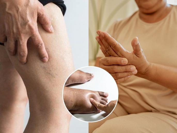 Swelling in hands and feet? It could be a sign of a serious illness | हाता-पायाला सारखी सूज येते? असू शकते गंभीर आजाराचे लक्षण, वेळीच करा 'हे' उपाय