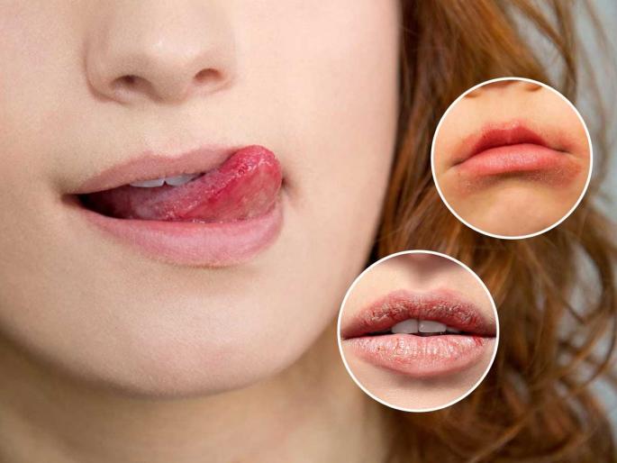 harmful effects of lip licking syndrome lip licking syndrome in winter winter lip licking habit side effects | कोरड्या ओठांवरुन जीभ फिरवणं पडेल महागात! होऊ शकतो 'लीप सिकींग सिंड्रोम'चा गंभीर आजार - डर्मेटोलॉजिस्ट सांगतात... harmful effects of lip licking syndrome lip licking syndrome in winter winter lip licking habit side effects | कोरड्या ओठांवरुन जीभ फिरवणं पडेल महागात! होऊ शकतो 'लीप सिकींग सिंड्रोम'चा गंभीर आजार - डर्मेटोलॉजिस्ट सांगतात...