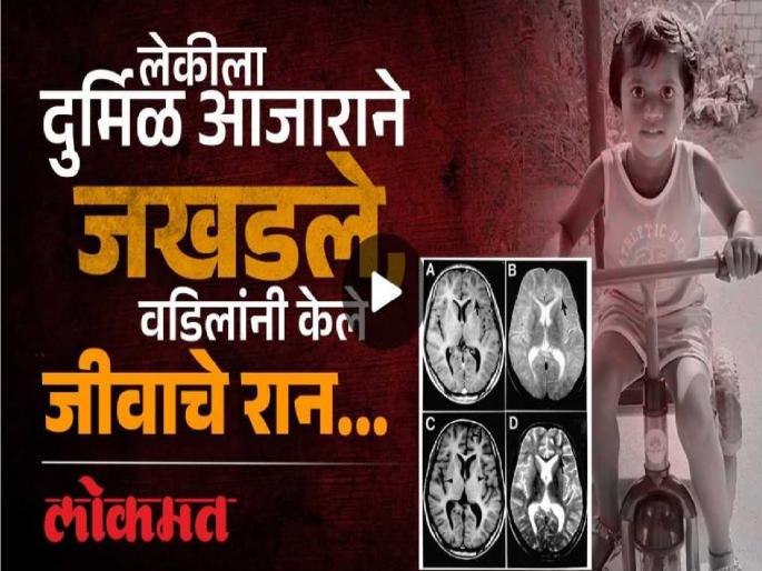Sagar Pujari's daughter from Hatkanangle taluka in Kolhapur suffers from a rare disease called SSPE Injections brought from abroad for treatment | Kolhapur: लेक एसएसपीई या दुर्मिळ आजाराने ग्रस्त, वडिलांनी परदेशातून आणले इंजेक्शन; पुजारी कुटुंबियांची हृदयद्रावक कहाणी Sagar Pujari's daughter from Hatkanangle taluka in Kolhapur suffers from a rare disease called SSPE Injections brought from abroad for treatment | Kolhapur: लेक एसएसपीई या दुर्मिळ आजाराने ग्रस्त, वडिलांनी परदेशातून आणले इंजेक्शन; पुजारी कुटुंबियांची हृदयद्रावक कहाणी