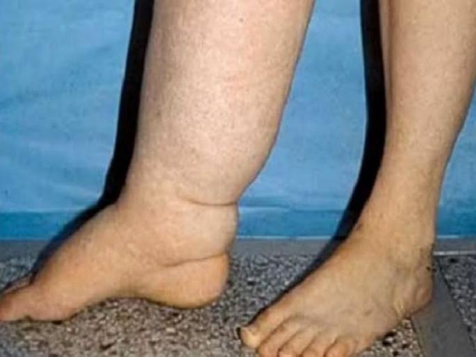 23,823 Lymphatic filariasis patients in East Vidarbha; Most in Chandrapur, Gadchiroli district | पूर्व विदर्भात हत्तीपायाचे २३,८२३ रुग्ण; सर्वाधिक 'या' जिल्ह्यांत 23,823 Lymphatic filariasis patients in East Vidarbha; Most in Chandrapur, Gadchiroli district | पूर्व विदर्भात हत्तीपायाचे २३,८२३ रुग्ण; सर्वाधिक 'या' जिल्ह्यांत