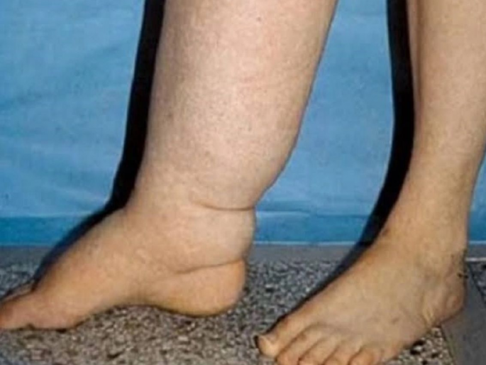 Five districts in the state are at risk of elephantiasis; Active health system, what causes this disease? | राज्यातील पाच जिल्ह्यांना हत्तीरोगाचा धोका; आरोग्य यंत्रणा सक्रिय, कशामुळे होतो हा रोग?  Five districts in the state are at risk of elephantiasis; Active health system, what causes this disease? | राज्यातील पाच जिल्ह्यांना हत्तीरोगाचा धोका; आरोग्य यंत्रणा सक्रिय, कशामुळे होतो हा रोग?