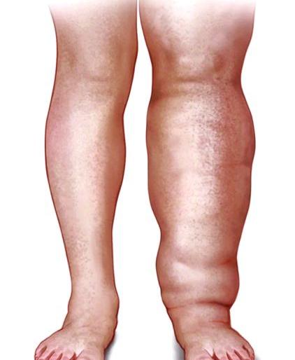 Prevention of elephantiasis; ignorance by citizens in Nagpur | हत्तीरोग दुरीकरणात सुशिक्षितांची आडकाठी; दुष्परिणामाची माहिती असतानाही उदासीनता Prevention of elephantiasis; ignorance by citizens in Nagpur | हत्तीरोग दुरीकरणात सुशिक्षितांची आडकाठी; दुष्परिणामाची माहिती असतानाही उदासीनता