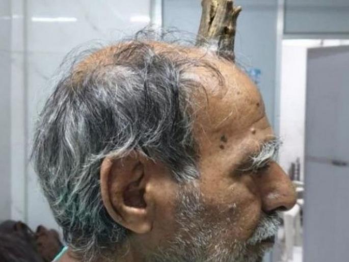 Madhya Pradesh sagar rahli village head horn elderly man shyamlal yadav | 'या' व्यक्तीच्या डोक्यावर उगवलं जनावरांसारखं शिंग, डॉक्टरकडे गेले आणि..... Madhya Pradesh sagar rahli village head horn elderly man shyamlal yadav | 'या' व्यक्तीच्या डोक्यावर उगवलं जनावरांसारखं शिंग, डॉक्टरकडे गेले आणि.....
