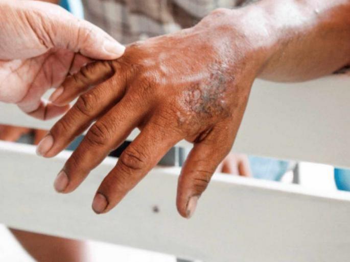 pune news 4,942 new leprosy patients found in the state; Survey finds one percent of more than 5 lakh suspects affected | चिंताजनक..! राज्यात आढळले ४,९४२ नवे कुष्ठरुग्ण; सर्वेक्षणात ५ लाखांहून अधिक संशयितांपैकी एक टक्का बाधित