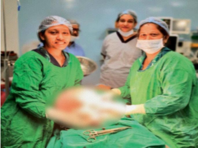 A 10 kg water ball was removed from the woman's stomach | महिलेच्या पोटातून काढला १० किलोंचा पाण्याचा गोळा A 10 kg water ball was removed from the woman's stomach | महिलेच्या पोटातून काढला १० किलोंचा पाण्याचा गोळा