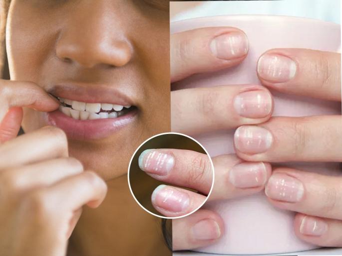 Do you have white spots on your nails? These spots are a sign of illness, read to learn more | तुमच्याही नखांवर पांढरे डाग आहेत का? हे डाग म्हणजे आजार की गंभीर आजाराची लक्षणं