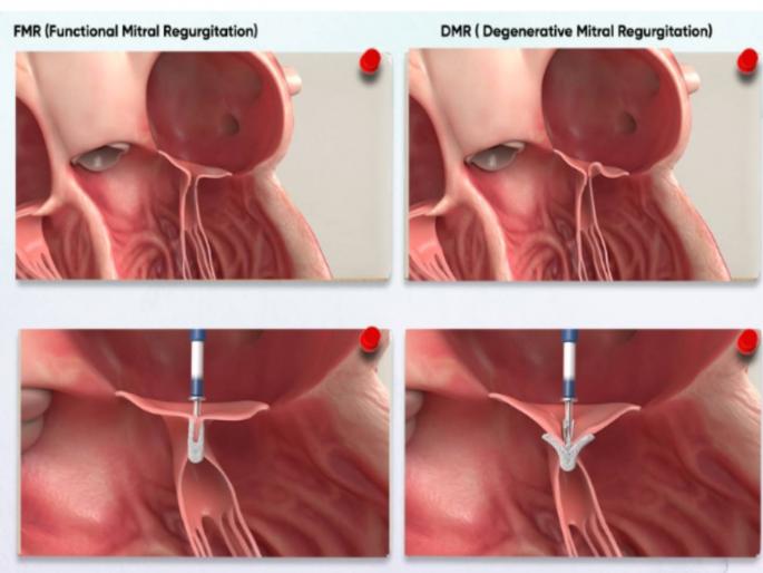 Heart repair option without surgery TEER procedure | शस्त्रक्रियेशिवाय हृदय दुरुस्तीचा पर्याय: TEER प्रक्रिया