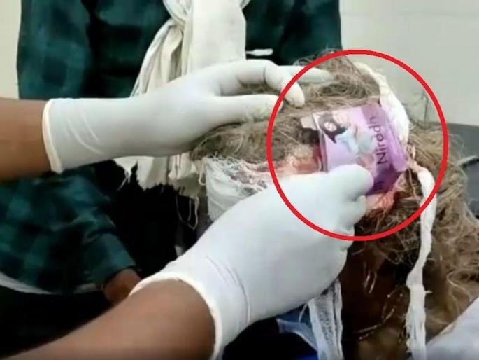 The woman's head was injured, while dressing, the doctor stuck a condom packet instead of cotton | महिलेच्या डोक्याला झाली होती जखम, मलमपट्टी करताना डॉक्टरांनी कापसाच्या जागी चिकटलं कंडोमचं पाकीट The woman's head was injured, while dressing, the doctor stuck a condom packet instead of cotton | महिलेच्या डोक्याला झाली होती जखम, मलमपट्टी करताना डॉक्टरांनी कापसाच्या जागी चिकटलं कंडोमचं पाकीट