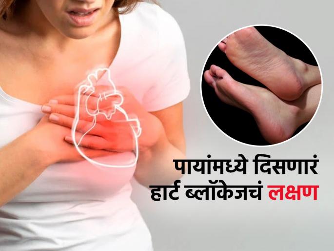 This sign in feet could be a sign of heart block | पायांवरचं ‘हे’ एक लक्षणही सांगतं की हृदयात ब्लॉकेज असू शकतं, डॉक्टर सांगतात-लक्ष द्या, शरीराचं ऐका