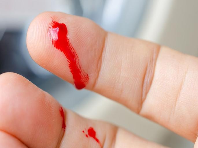 Know what is hemophila disorder and what are the causes of this disease | जाणून घ्या काय आहे हीमोफीलिया?; छोटीशी जखमही ठरू शकते जीवघेणी Know what is hemophila disorder and what are the causes of this disease | जाणून घ्या काय आहे हीमोफीलिया?; छोटीशी जखमही ठरू शकते जीवघेणी