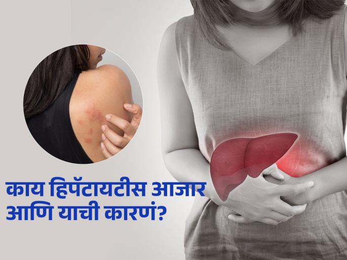 World Hepatitis Day 2025 : What is the causes, saymtoms of liver disease hepatitis | World Hepatitis Day 2025: ‘या’ घातक सवयींमुळे वाढतंय हिपॅटायटीसचं प्रमाण, पाहा धोके आणि उपाय