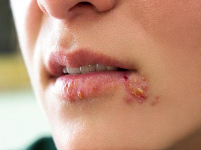 Herpes is communicable disease, precaution necessary | कशामुळे होतो नागीण आजार? जाणून कारणे आणि लक्षणे! Herpes is communicable disease, precaution necessary | कशामुळे होतो नागीण आजार? जाणून कारणे आणि लक्षणे!