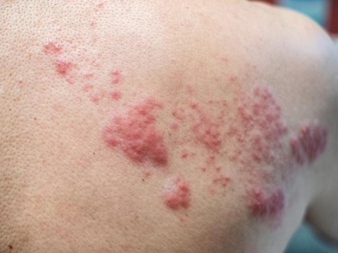 Herpes Zoster disease Know 5 myths and facts about herpes disease that you might not know | Herpes Zoster: दोन टोकं एकमेकांना भेटली तर...; जाणून घ्या 'नागीण' आजाराविषयीचे ५ गैरसमज आणि तथ्यं! Herpes Zoster disease Know 5 myths and facts about herpes disease that you might not know | Herpes Zoster: दोन टोकं एकमेकांना भेटली तर...; जाणून घ्या 'नागीण' आजाराविषयीचे ५ गैरसमज आणि तथ्यं!