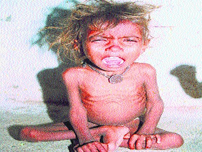 Malnutrition infection in urban areas of Panvel | पनवेलच्या शहरी भागात कुपोषणाची लागण Malnutrition infection in urban areas of Panvel | पनवेलच्या शहरी भागात कुपोषणाची लागण