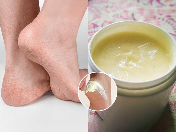 how to reduce cracked heel problems, home made cream to get relief from cracked heel  | तळपायांना पडलेल्या भेगा काही दिवसांतच होतील गायब- 'हे' घरगुती क्रिम वापरा- टाचा होतील मऊ, कोमल