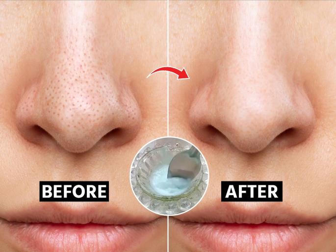 skin care tips, Is your nose getting dark because of blackheads? Does it itch? Try this special home remedy | ब्लॅकहेड्समुळे नाक फार काळवंडलं? सारखी खाज सुटते ? करा हे खास घरगुती उपाय