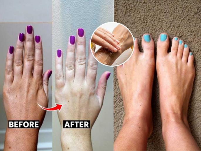 tips & tricks home remedy to remove darkness hands and feet home remedy to remove dark hands and feet how to remove dark hands and feet naturally | हिवाळ्यात हातापायाची त्वचा काळवंडली? करा लिंबू - साखरेचा उत्तम उपाय - निस्तेज त्वचाही होईल उजळ... tips & tricks home remedy to remove darkness hands and feet home remedy to remove dark hands and feet how to remove dark hands and feet naturally | हिवाळ्यात हातापायाची त्वचा काळवंडली? करा लिंबू - साखरेचा उत्तम उपाय - निस्तेज त्वचाही होईल उजळ...