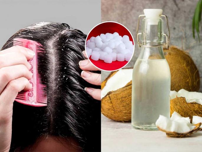homemade natural remedy for dandruff camphor and coconut oil for dandruff home remedies to remove dandruff | कापराच्या ४ वड्या - अर्धा लिंबू घेऊन ‘असा’ करा उपाय - डोक्यातला कोंडा एका धुण्यात जाईल पळून... homemade natural remedy for dandruff camphor and coconut oil for dandruff home remedies to remove dandruff | कापराच्या ४ वड्या - अर्धा लिंबू घेऊन ‘असा’ करा उपाय - डोक्यातला कोंडा एका धुण्यात जाईल पळून...