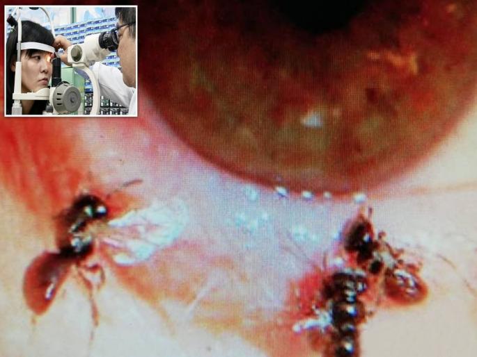 Doctors find live four bees inside woman's eye where they were drinking her tears | बाबो! महिलेचे अश्रू पिण्यासाठी डोळ्यात घुसल्या मधमाश्या, डॉक्टरही झाले हैराण! Doctors find live four bees inside woman's eye where they were drinking her tears | बाबो! महिलेचे अश्रू पिण्यासाठी डोळ्यात घुसल्या मधमाश्या, डॉक्टरही झाले हैराण!