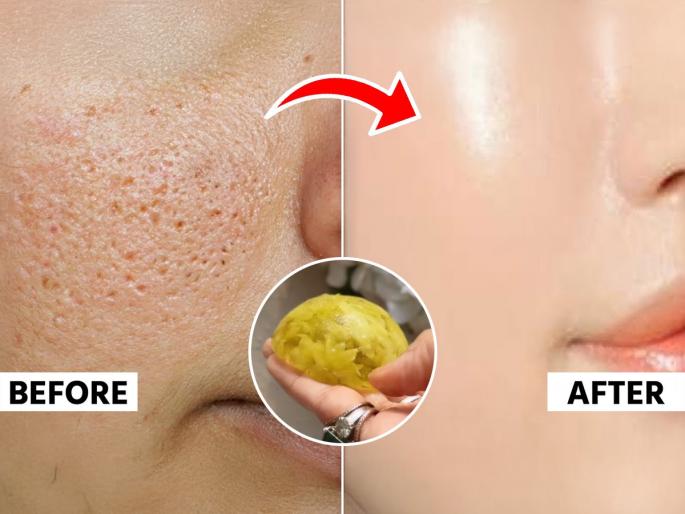 Best Natural & Effective Home Remedies for Open Pores Natural Home Remedies for Open Pores How to Close Pores | बिनपैशांचा घरगुती उपाय-‘या’ पांढऱ्या फुलांची जादू-चेहऱ्यावरचे ओपन पाेर्स करते गायब...