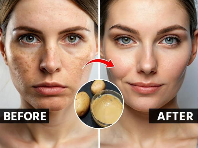 how to get rid of pigmentation and dark circles, use of potato to reduce pigmentation on skin and dark circles  | चेहऱ्यावरचं पिगमेंटेशन, डोळ्यांभोवतीची काळी वर्तुळे वाढली? 'या' पद्धतीने बटाटा वापरा- त्वचा होईल देखणी