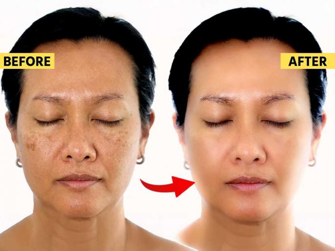 how to reduce black spots from cheeks how to reduce pigmentation at home face pigmentation home remedies, | काळे डाग, पिगमेंटेशन होईल कायमचे गायब! किचनमधील फक्त एकच पदार्थ असरदार - त्वचा होईल बेबी सॉफ्ट... how to reduce black spots from cheeks how to reduce pigmentation at home face pigmentation home remedies, | काळे डाग, पिगमेंटेशन होईल कायमचे गायब! किचनमधील फक्त एकच पदार्थ असरदार - त्वचा होईल बेबी सॉफ्ट...