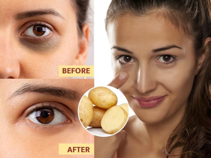 how to reduce dark circle, use of potato juice for reducing dark circles, home hacks to get rid of dark circles  | डार्क सर्कल्स वाढल्याने डोळे खोल गेल्यासारखे दिसतात? करा बटाट्याचा ‘हा’ उपाय- काळी वर्तुळं गायब