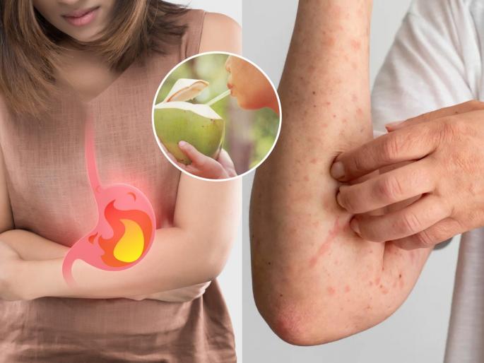 pitta dosha skin allergy treatment fastest way to cure pitta home remedies for pitta allergy ayurvedic remedy for pitta | अंगावर पित्ताचे लालसर चट्टे येतात, खाज येते? घरगुती ५ उपाय- पित्ताचा त्रास कायमचा होईल कमी...