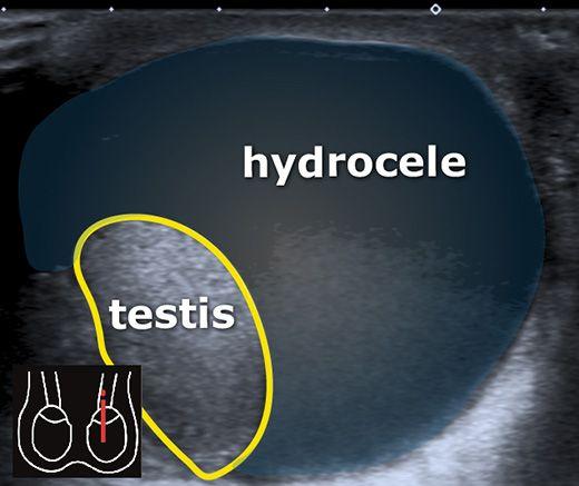 Hydrocele Patient negligence: Directives for Disciplinary Action on Inaction | हायड्रोसीलच्या रुग्णांची हेळसांड : अकार्यक्षमतेबाबत शिस्तभंगाची कारवाई करण्याचे निर्देश Hydrocele Patient negligence: Directives for Disciplinary Action on Inaction | हायड्रोसीलच्या रुग्णांची हेळसांड : अकार्यक्षमतेबाबत शिस्तभंगाची कारवाई करण्याचे निर्देश