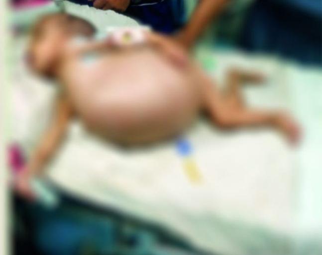 Surprise: By birth fetus in child's stomach: Three cases found in Medical | आश्चर्य : जन्मत: बालकाच्या पोटात गर्भ : मेडिकलमध्ये आढळली तीन प्रकरणे Surprise: By birth fetus in child's stomach: Three cases found in Medical | आश्चर्य : जन्मत: बालकाच्या पोटात गर्भ : मेडिकलमध्ये आढळली तीन प्रकरणे